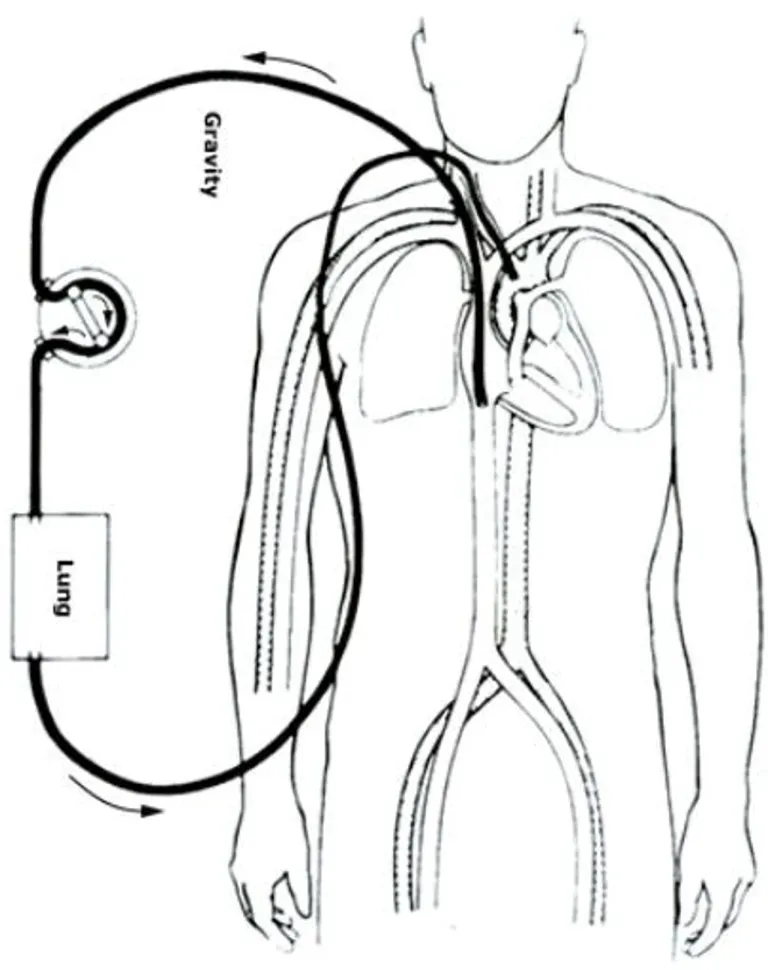 Veno arterial (VA)