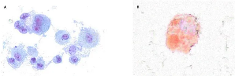 Microscopy_of_a_bronchoalveolar_lavage_sample