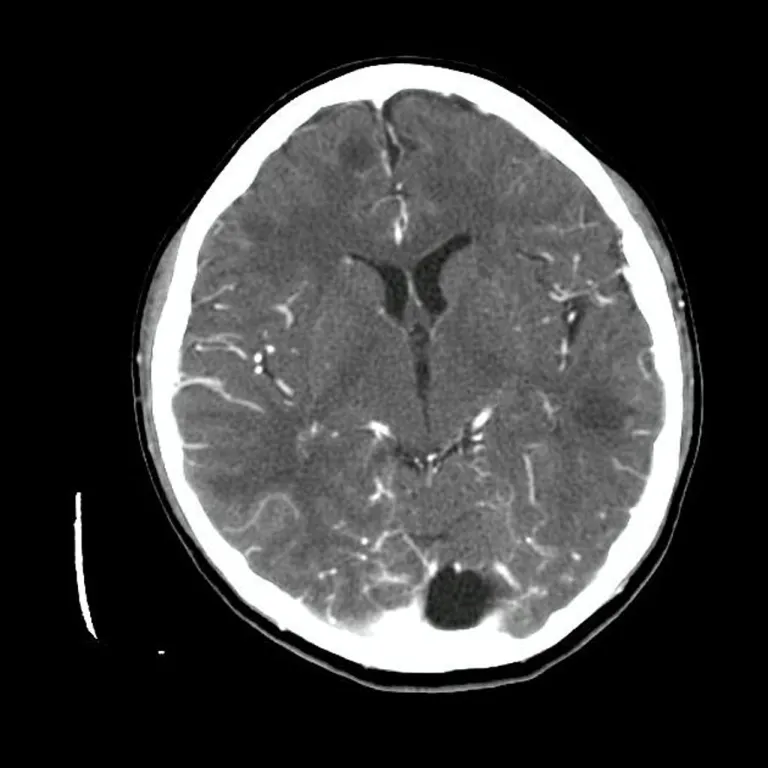ภาพ CT Scan ของสมองผู้ป่วย PAM แสดงให้เห็นถึง Hypodense Regions ในสมองและการอุดตันของเส้นเลือด
