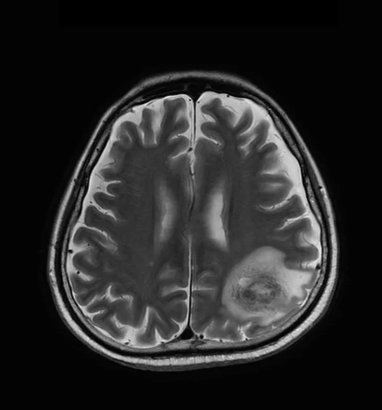 ภาพ MRI T2 แสดงให้เห็นถึงสมองของผู้ป่วยติดเชื้ออะมีบาชนิดอื่นในสมอง แสดงให้เห็นถึงความเสียหายต่อเนื้อเยื่อสมอง