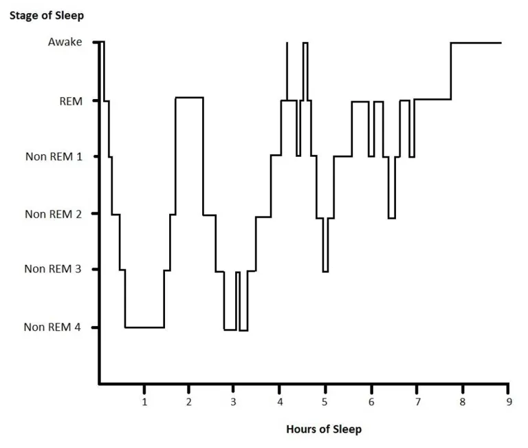 Hypnogram หรือกราฟแสดงระดับการนอนหลับ