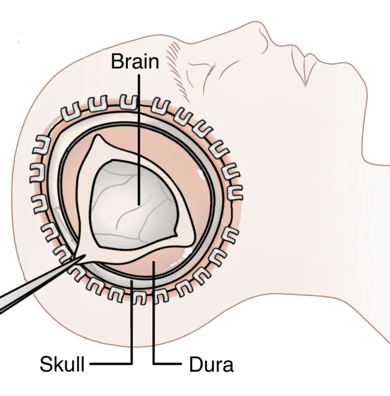 Decompressive Craniectomy ซึ่งเป็นหัตถการสำหรับลดแรงดันภายในกะโหลก