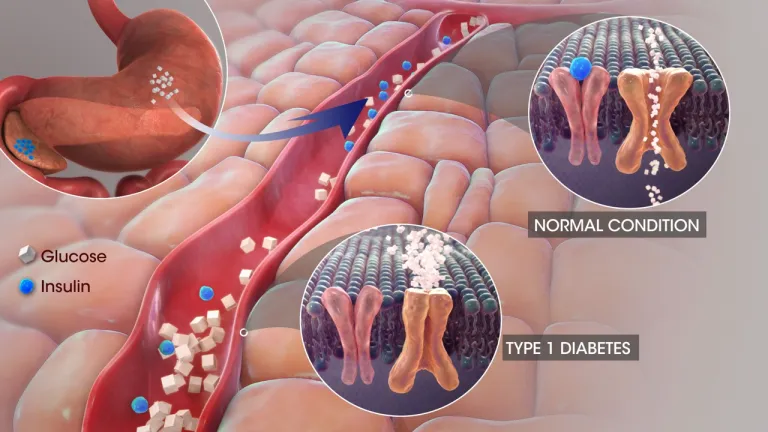 โรคเบาหวานชนิดที่ 1 เกิดจากความผิดปกติในการผลิต Insulin จากเซลล์ในตับอ่อน หรือการตอบสนองต่อ Insulin ที่ผิดปกติ