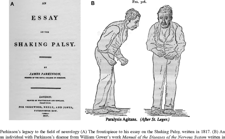 บทความเรื่อง Shaking Palsy ของเจมส์ พาร์กินสัน