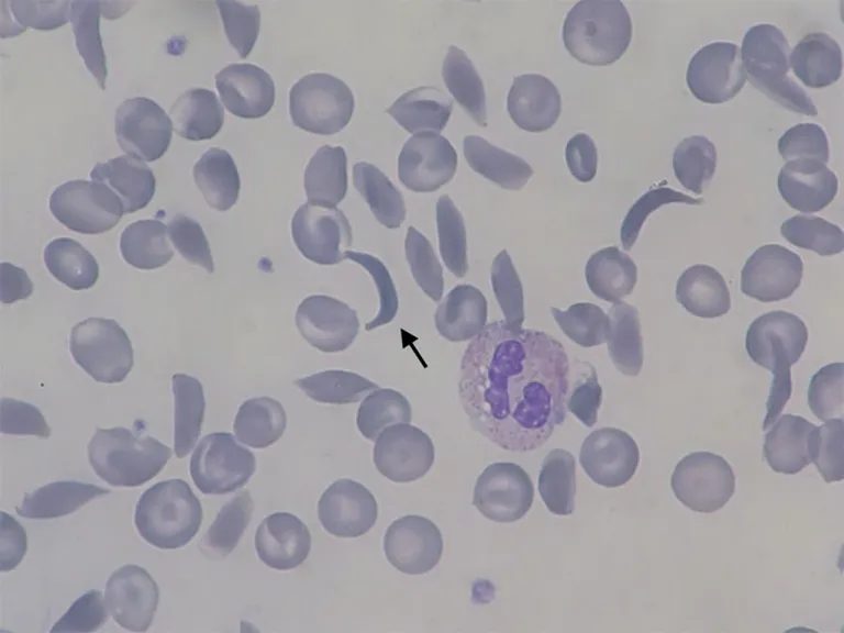 Blood Smear ของผู้ป่วย SCD แสดงให้เห็นเม็ดเลือดแดงรูปเคียว