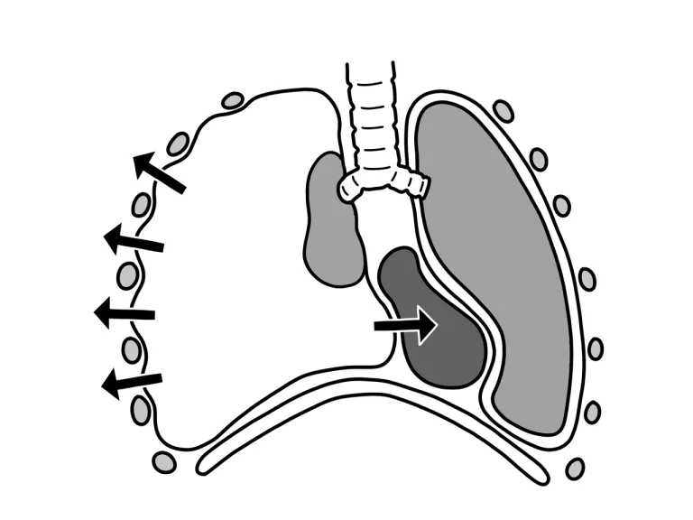 ภาพแสดง Tension Pneumothorax รุนแรงจนอากาศจากปอดข้างที่รั่วดันหลอดลมและปอดอีกข้างไปด้วย