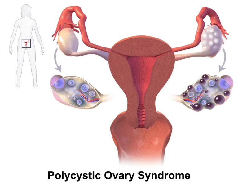 ภาพจำลองแสดงรังไข่ที่มีภาวะ PCOS