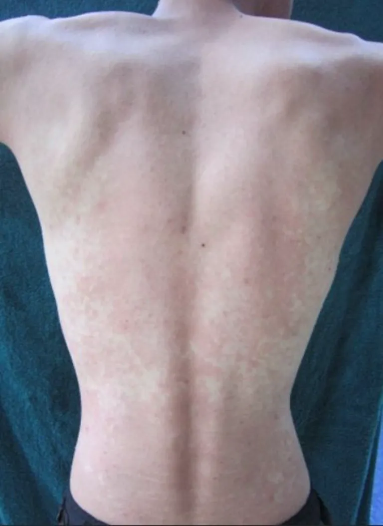 ผื่นคล้ายผื่นแพ้ในผู้ที่มีอาการ Asian Flush Syndrome