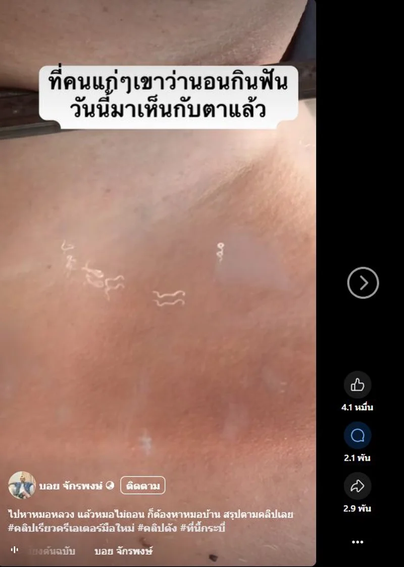 ภาพบันทึกหน้าจอแสดงภาพหนอนหลุดออกมาจากบริเวณใบหน้าซึ่งเจ้าของเฟซบุ๊กเชื่อว่าเป็น "หนอนกินฟัน"