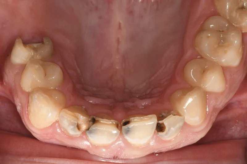 ภาพบันทึกหน้าจอแสดงตัวอย่างฟันผุ